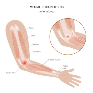 educational image showing the golfer elbow